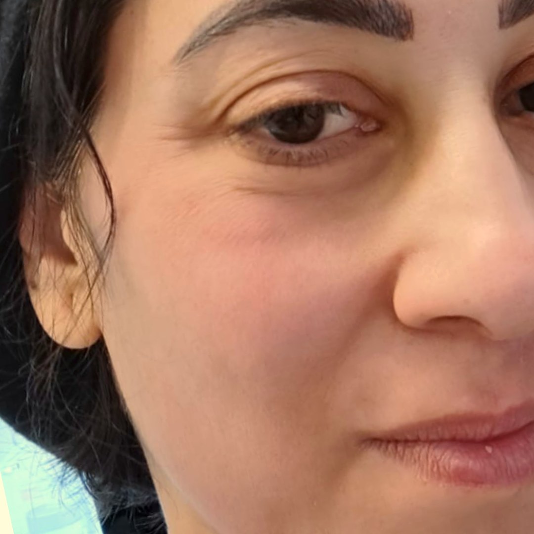 אותו אזור אחרי הטיפול