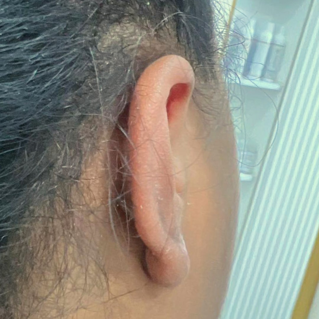 האוזן אחרי הטיפול