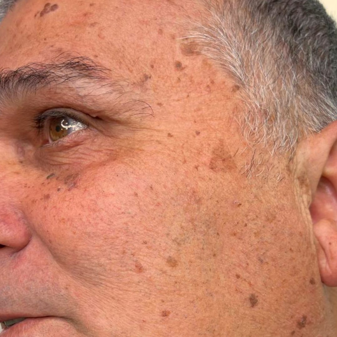כתמי שמש על הלחי לפני הטיפול
